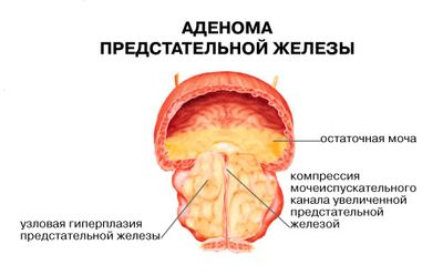 заболевание предстательной железы заболевание предстательной железы